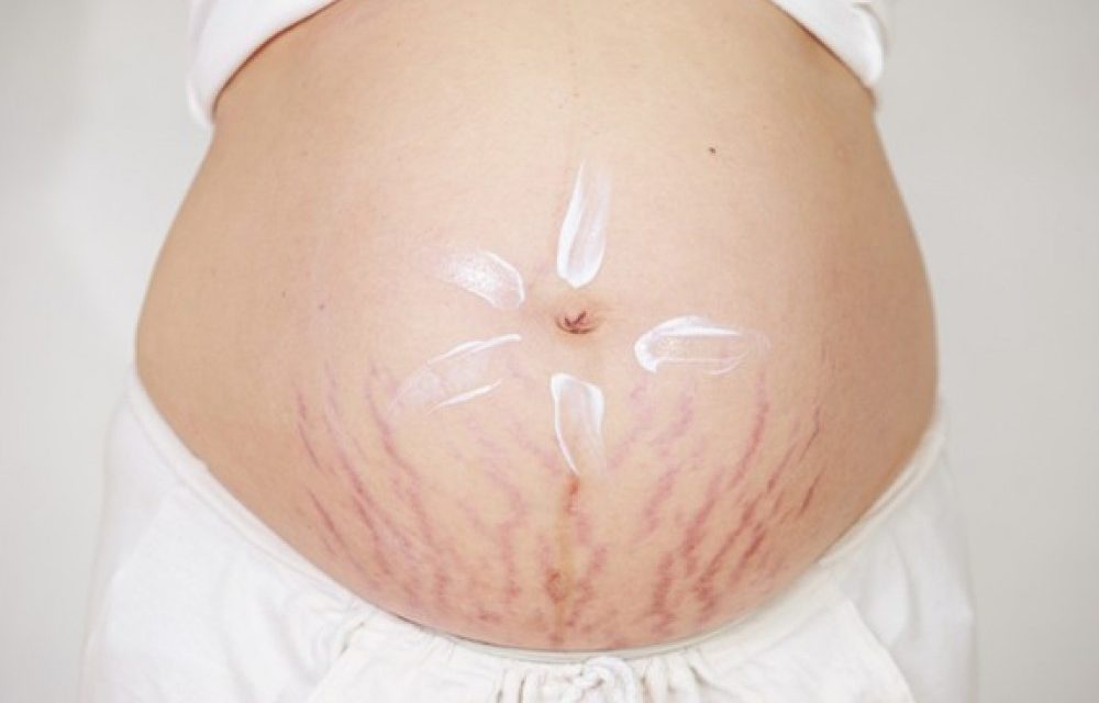 Tips Memulihkan Tubuh Setelah Melahirkan Secara Caesar