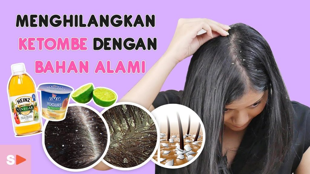 Cara Mengatasi Ketombe Membandel Secara Alami