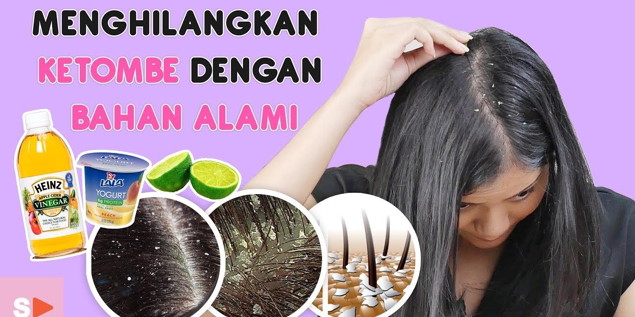 Cara Mengatasi Ketombe Membandel Secara Alami
