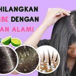 Cara Mengatasi Ketombe Membandel Secara Alami