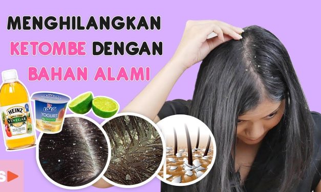 Cara Mengatasi Ketombe Membandel Secara Alami