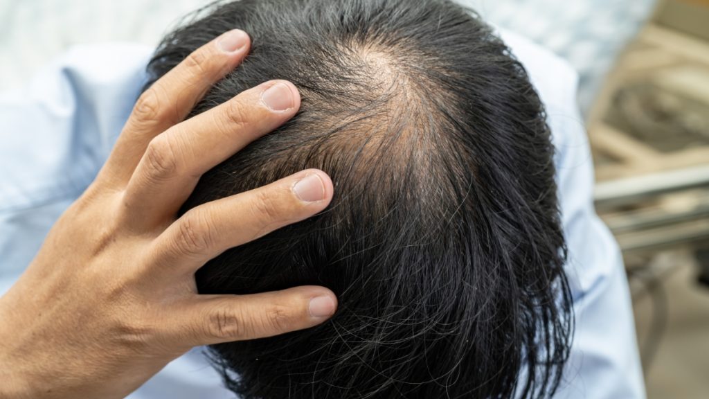 Tips Efektif Merawat Rambut Agar Kuat Dan Tidak Mudah Rontok